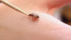 Odstranění klíštěte pinzetou z lidské pokožky, prevence boreliózy a klíšťové encefalitidy.